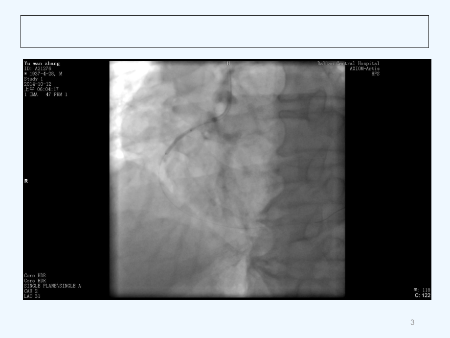 时家义急性冠脉综合征介入治疗策略课件.ppt_第3页