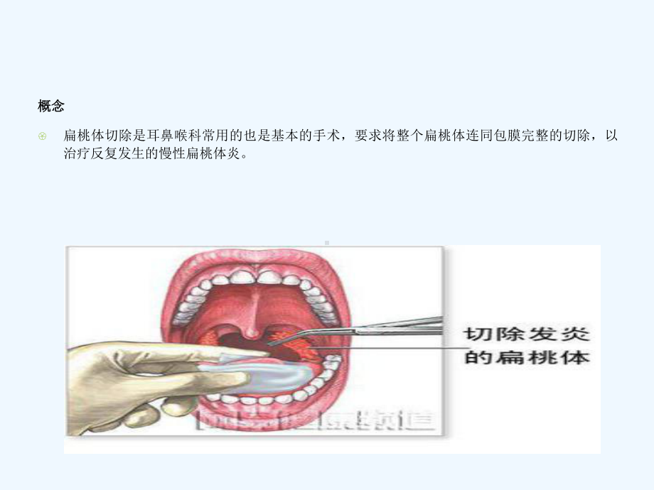 扁桃体术后护理N0N1课件.ppt_第2页