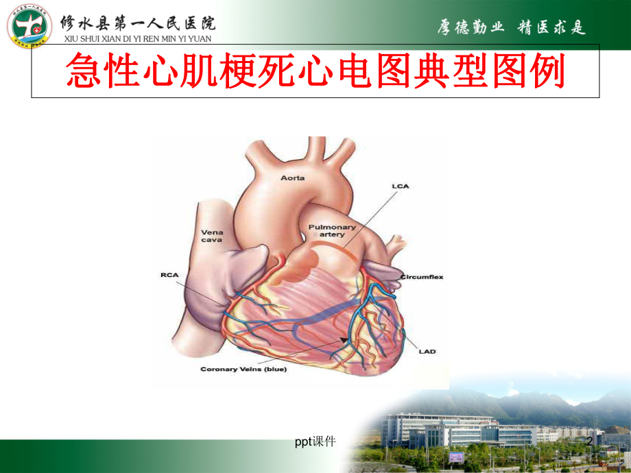 急性心肌梗死及常见心电图识别-课件.ppt_第2页