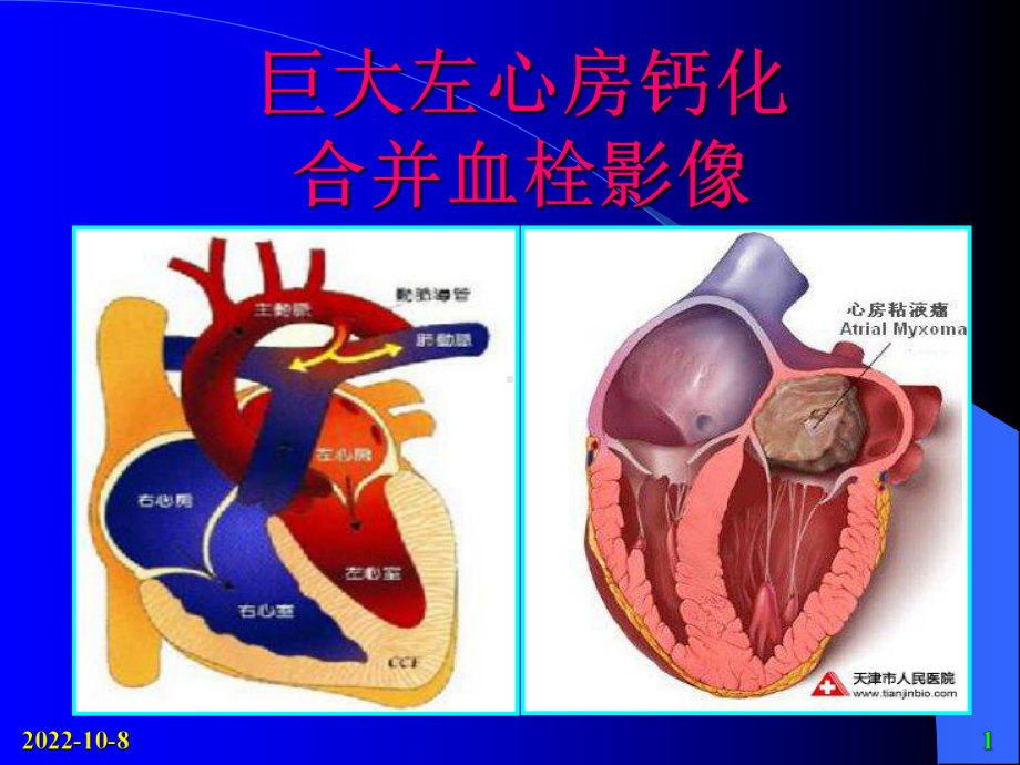 巨大左心房钙化合并血栓影像课件.pptx_第1页