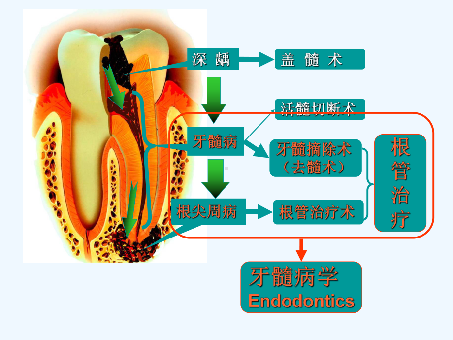 根管治疗的步骤方法器械-课件.ppt_第2页