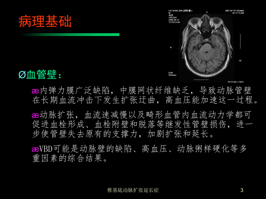 椎基底动脉扩张延长症培训课件.ppt_第3页