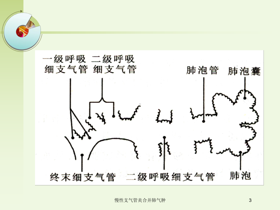 慢性支气管炎合并肺气肿培训课件.ppt_第3页