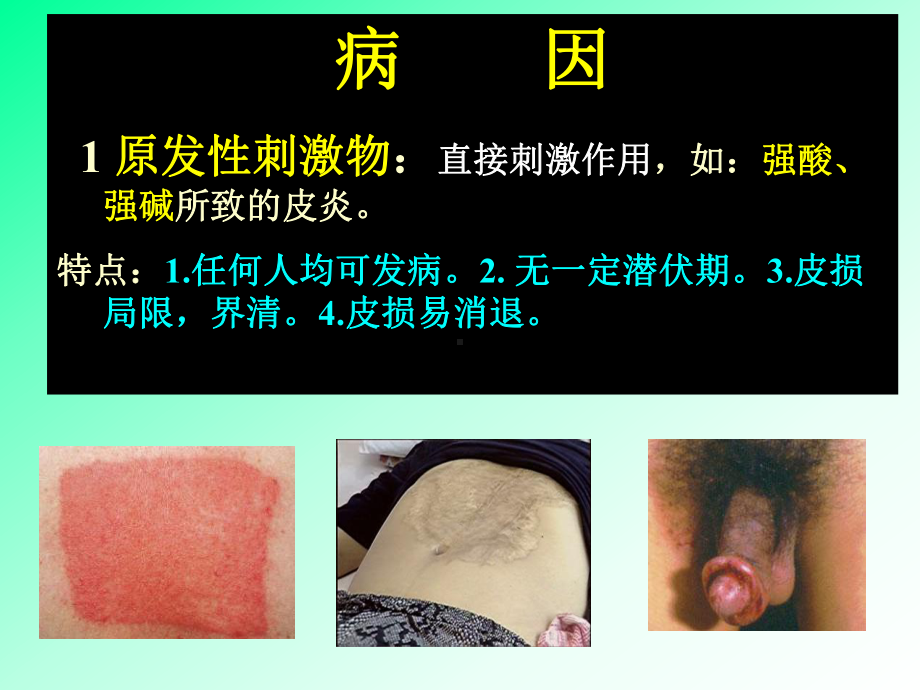 接触性皮炎湿疹课件.ppt_第2页