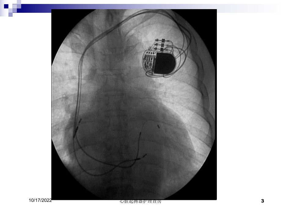 心脏起搏器护理查房培训课件.ppt_第3页