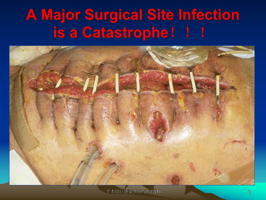 手术切口感染预防与控制课件1.ppt_第2页