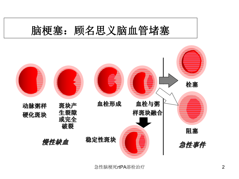 急性脑梗死rtPA溶栓治疗培训课件.ppt_第2页