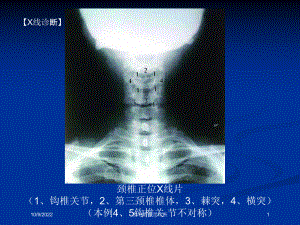 整脊影像学诊断培训课件.ppt