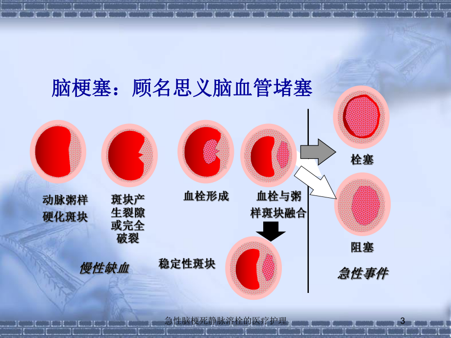 急性脑梗死静脉溶栓的医疗护理培训课件.ppt_第3页