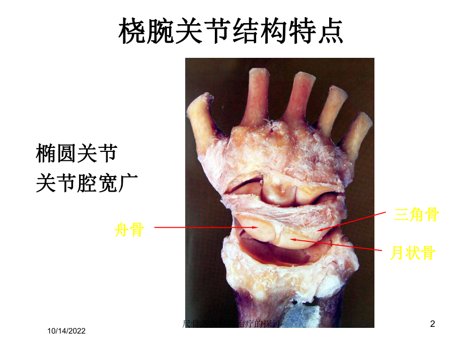 尺骨茎突骨折治疗的探讨课件.ppt_第2页