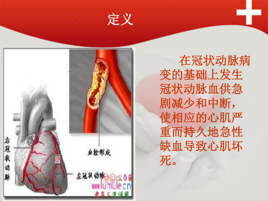 急性前壁心肌梗死护理查房李霞课件.ppt_第2页