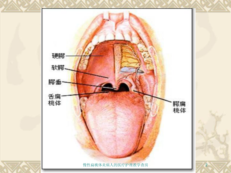 慢性扁桃体炎病人的医疗护理教学查房培训课件.ppt_第2页