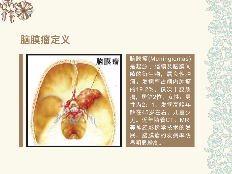 岩斜区脑膜瘤护理查房课件.ppt_第3页