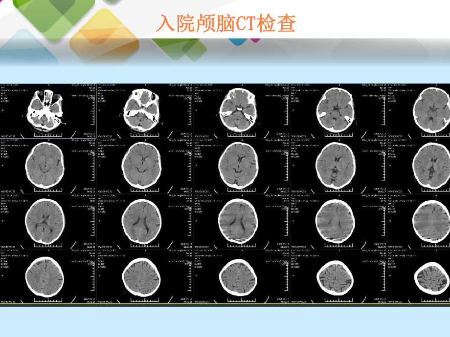 急性脑梗死动脉取栓治疗课件.pptx_第3页