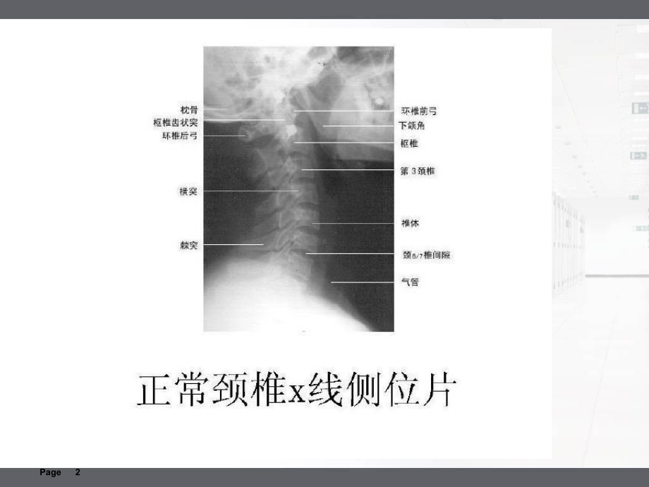 枕颌带牵引的护理课件.pptx_第2页