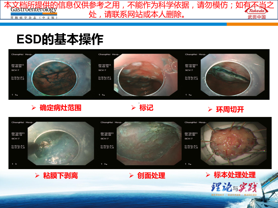 早期胃癌ESD治疗培训课件.ppt_第3页