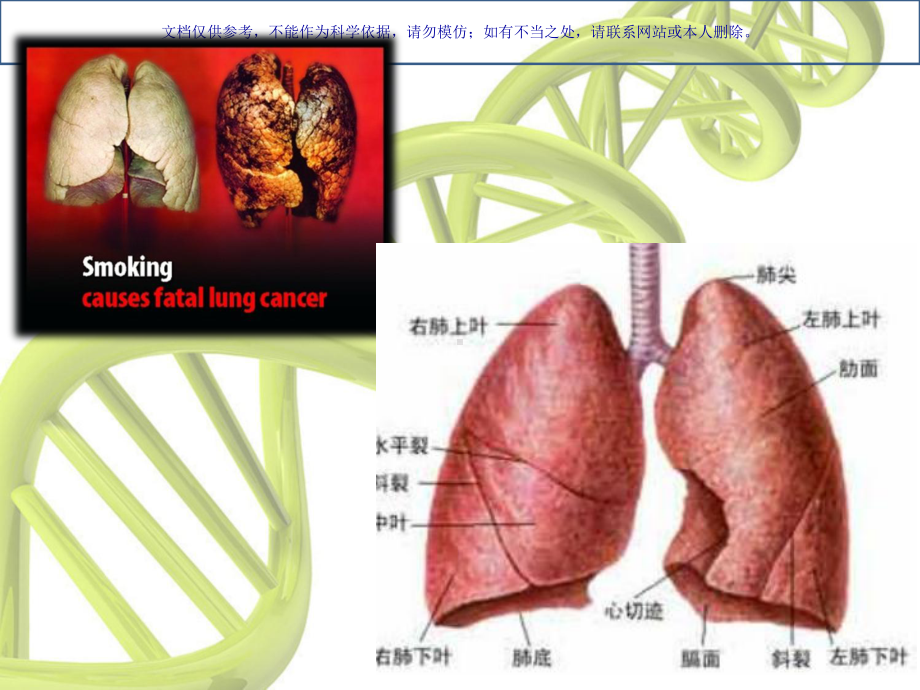 左上肺癌根治术课件.ppt_第2页