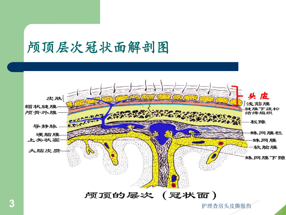 护理查房头皮撕脱伤培训课件.ppt_第3页