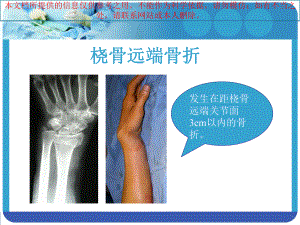 手法复位小夹板固定治疗Colles骨折培训课件.ppt