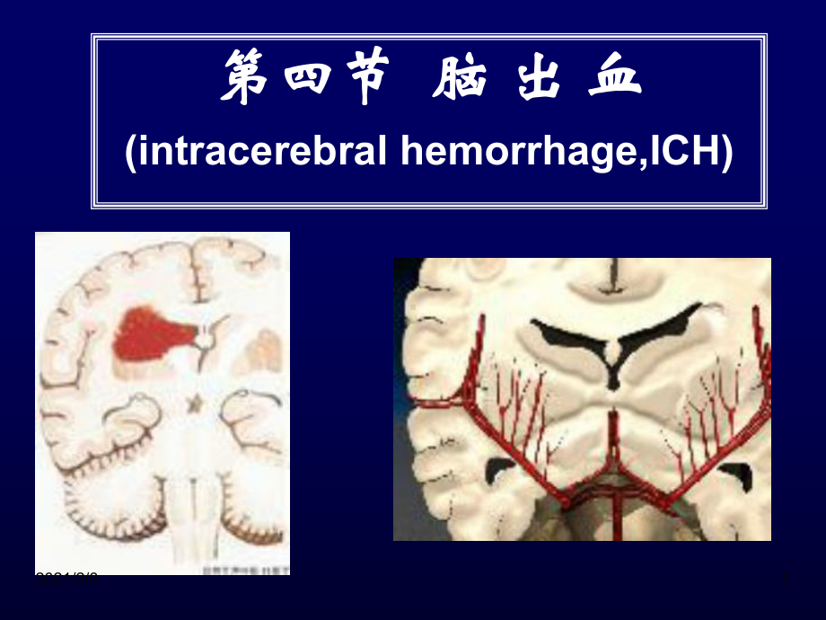 常见疾病病因与治疗方法-脑出血课件.ppt_第1页