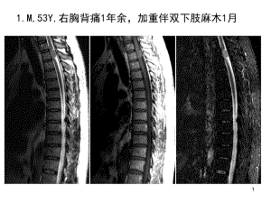 新编椎管髓外占位性病变影像诊断课件.ppt