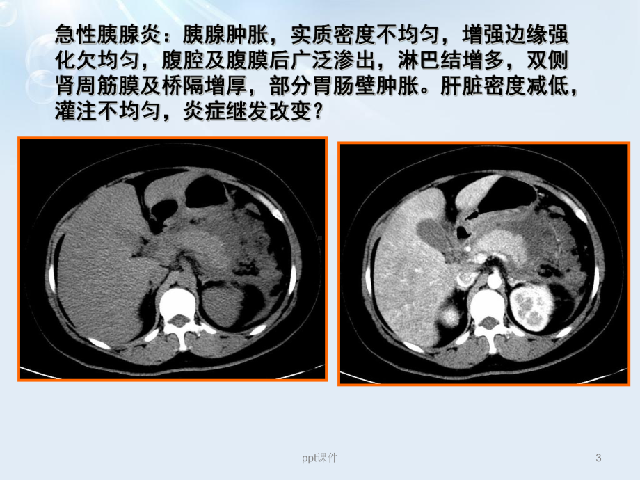 急性胰腺炎液体复苏-课件.ppt_第3页