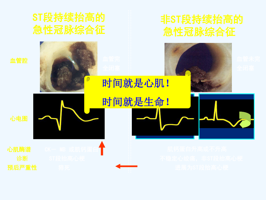 急性冠脉综合征患者主要治疗手段课件.ppt_第3页