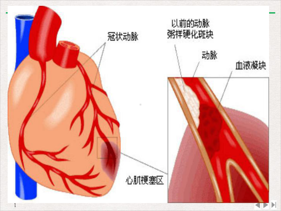 急性心肌梗死的急救护理完美课课件.ppt_第2页