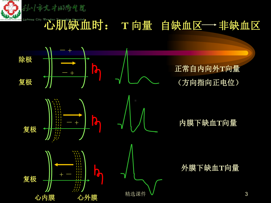 心肌缺血与心肌梗死的心电图改变课件.ppt_第3页