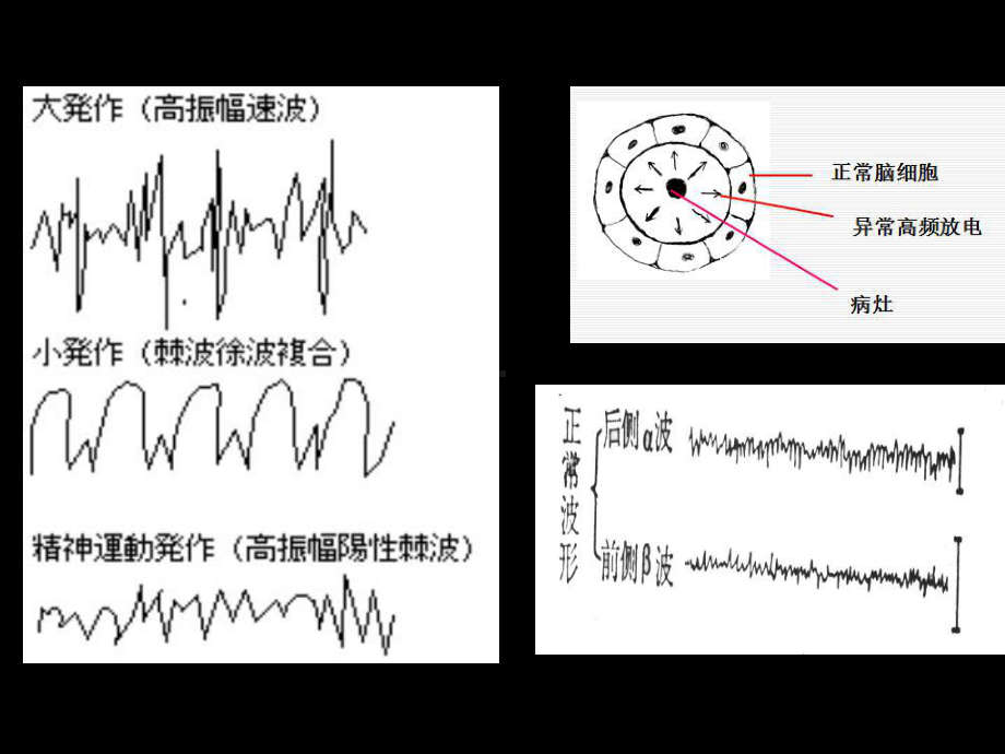 抗癫痫和抗惊厥课件.ppt_第3页