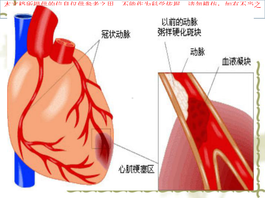 急性心肌梗死的急救医疗护理培训课件.ppt_第1页