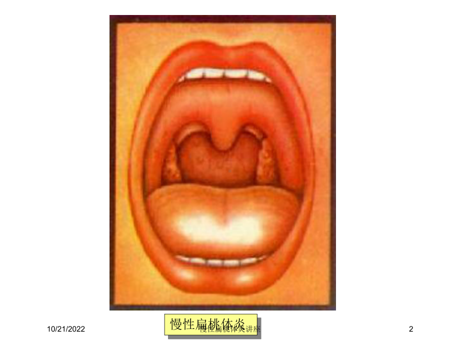 慢性扁桃体炎讲座培训课件.ppt_第2页