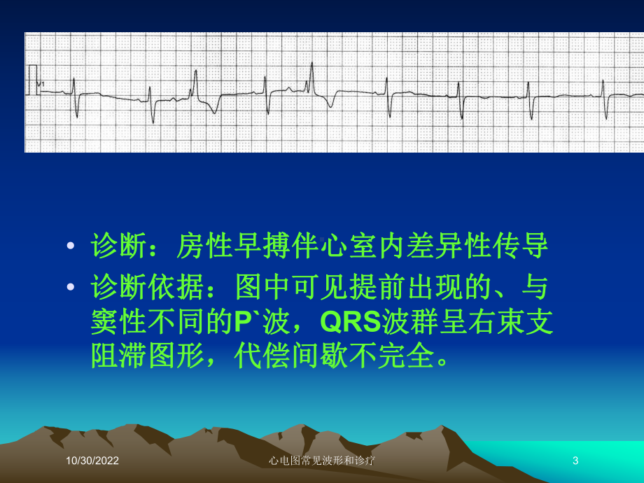 心电图常见波形和诊疗课件.ppt_第3页