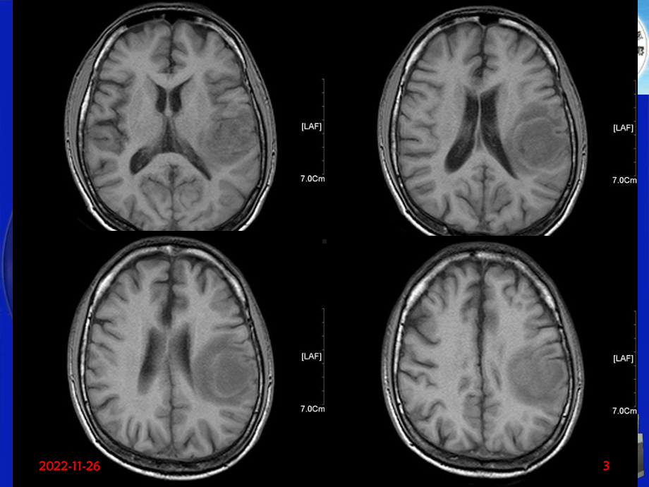 影像科经典读片之三脑淋巴瘤课件.ppt_第3页