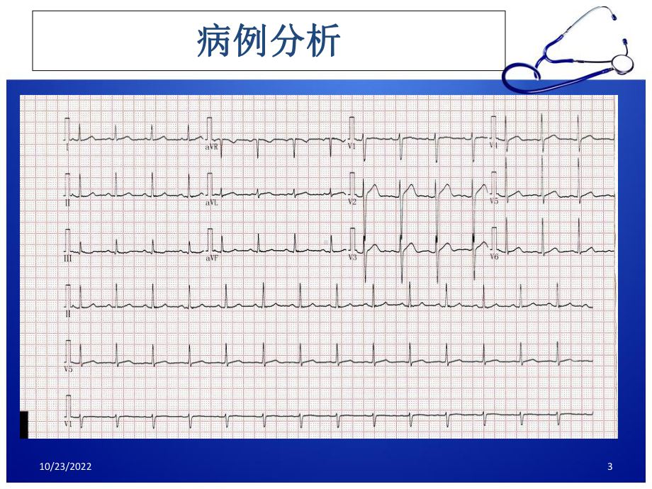 急性胸痛诊治流程学习课件.ppt_第3页