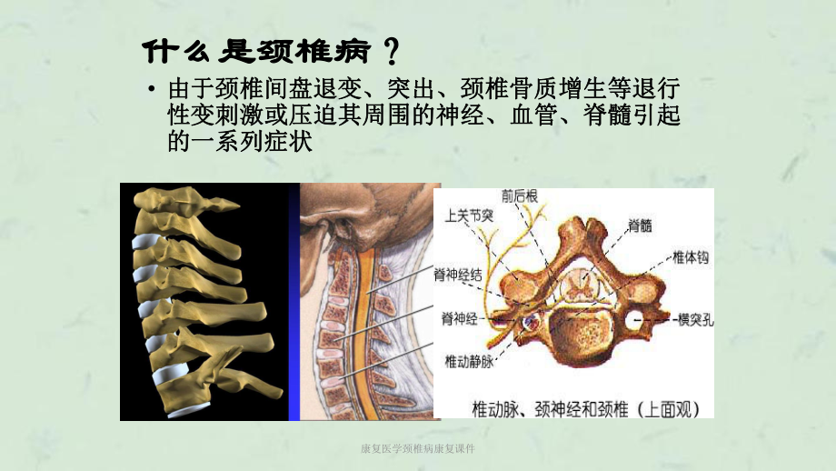 康复医学颈椎病康复课件.ppt_第3页