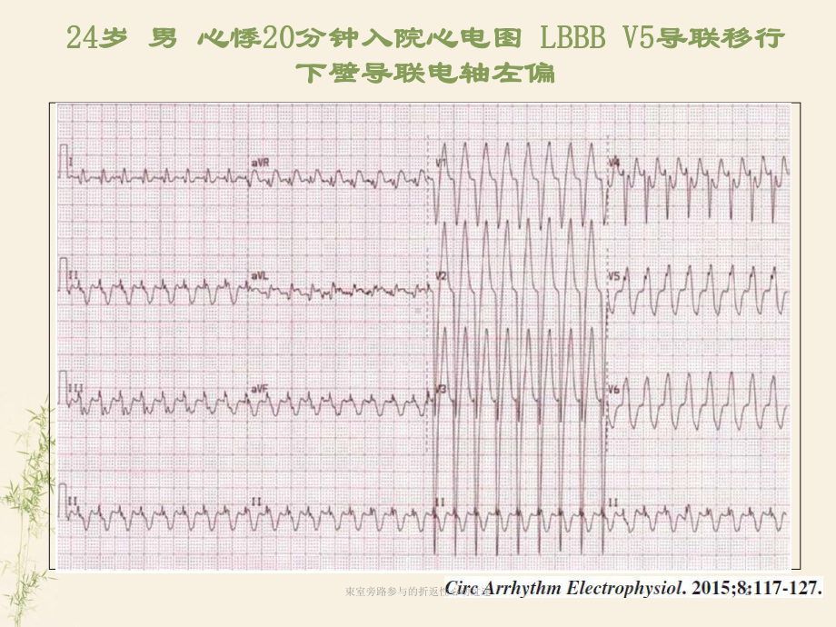 束室旁路参与的折返性心动过速培训课件.ppt_第2页