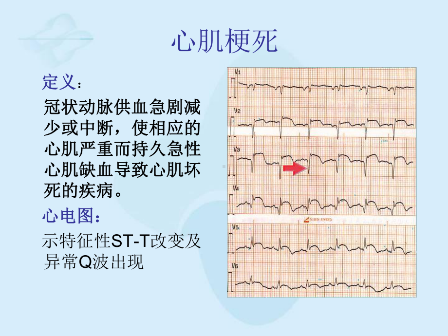 心肌梗死的心电图改变课件-2.ppt_第2页