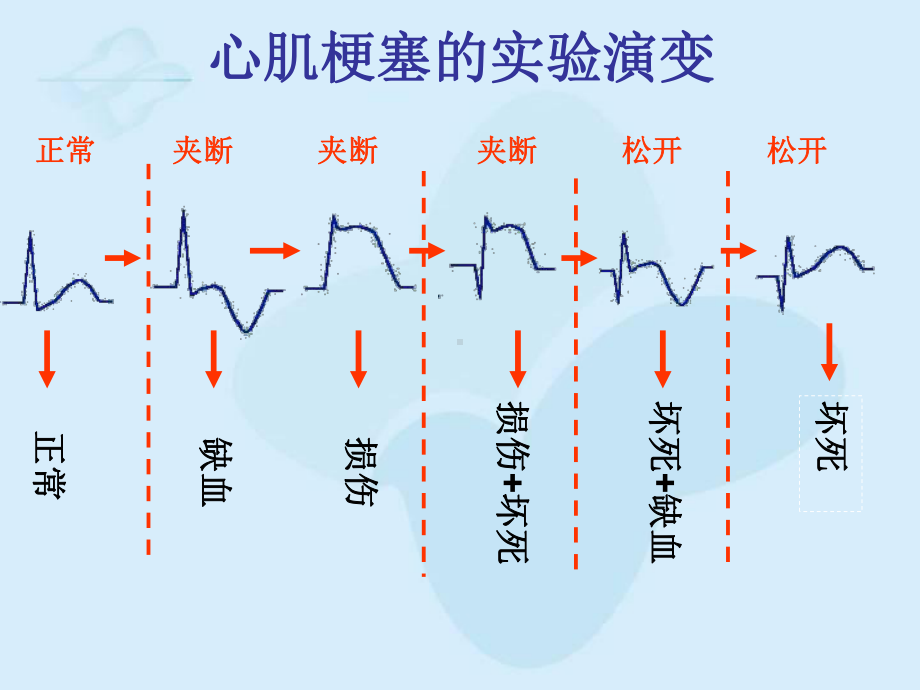 心肌梗死的心电图改变课件-2.ppt_第3页