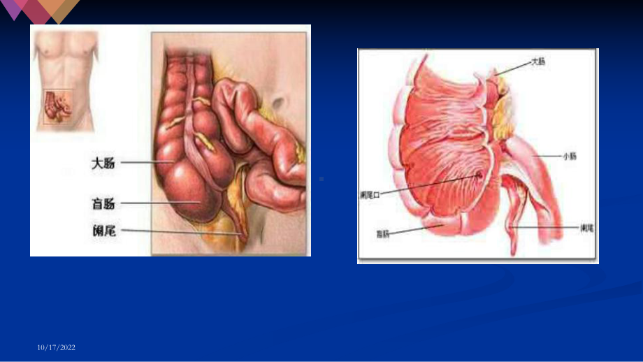 开腹阑尾的护理查房课件.ppt_第3页