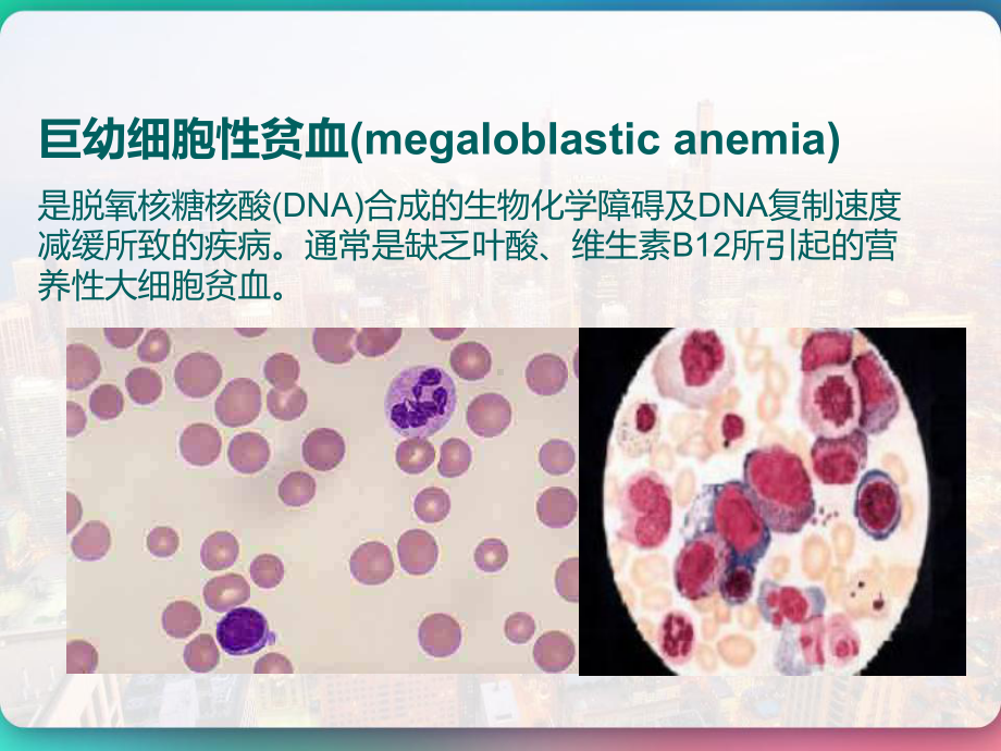 巨幼红细胞性贫血-课件.pptx_第2页