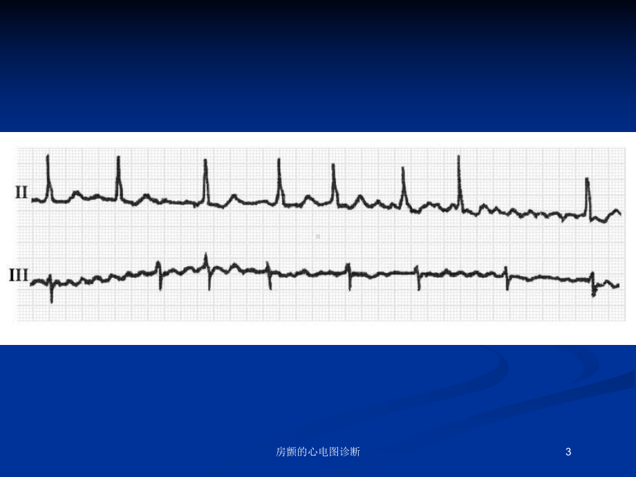房颤的心电图诊断培训课件.ppt_第3页