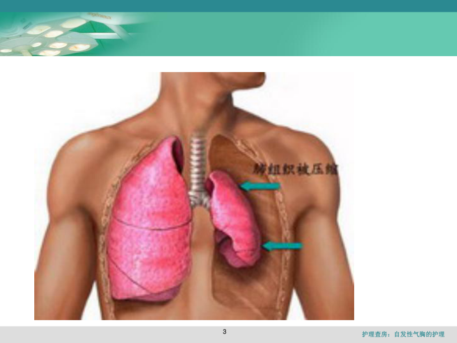 护理查房：自发性气胸的护理课件.ppt_第3页