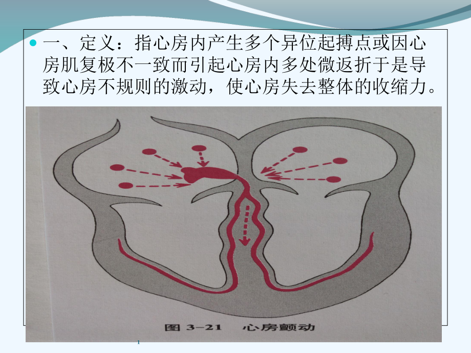 心房扑动心房纤颤临床与心电图课件.ppt_第2页