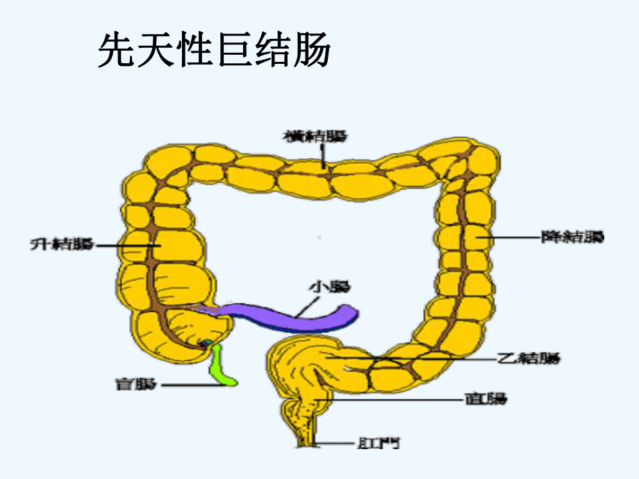 巨结肠洗肠流程课件.ppt_第3页