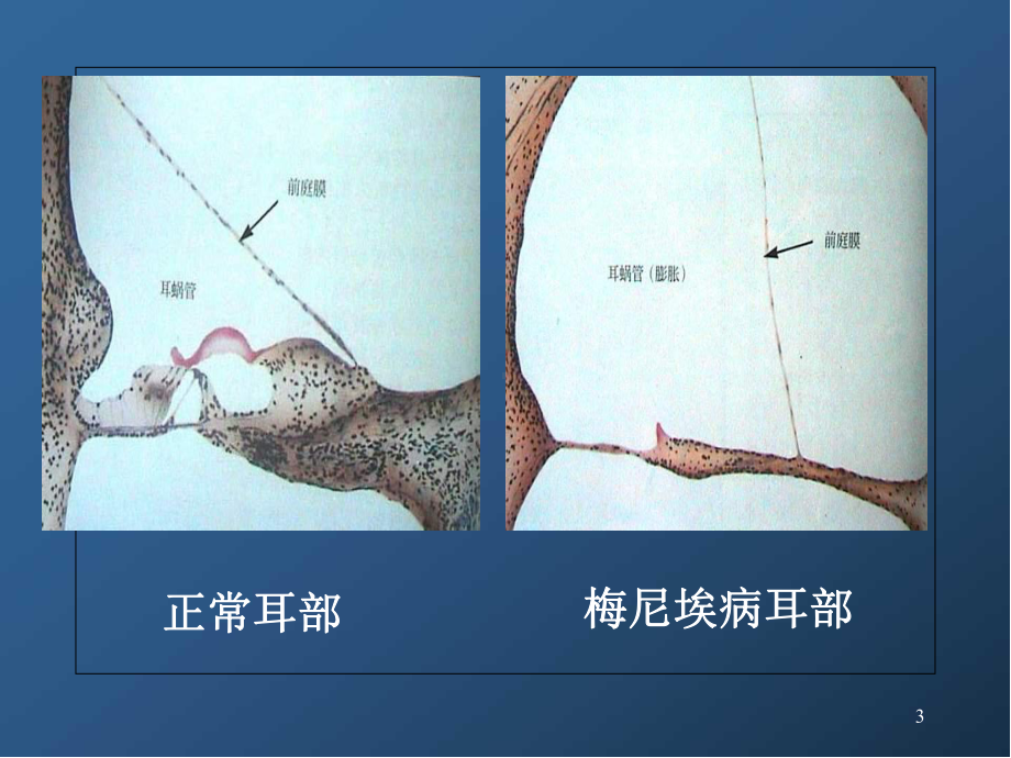 梅尼埃病及耳聋防治医学课件.ppt_第3页