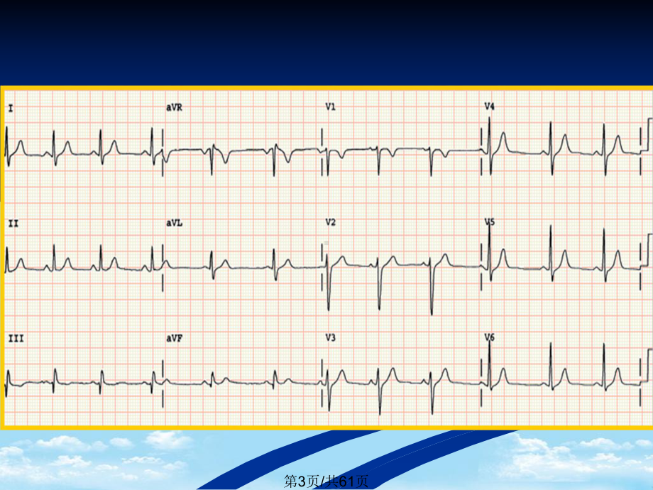 心电图全面版课件.pptx_第3页