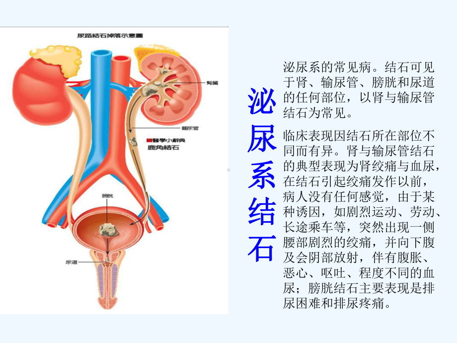 尿路结石及肾功能损害课件.ppt_第2页