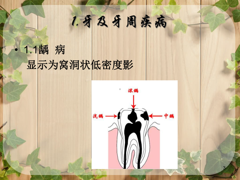 影像学牙牙周颌骨肿瘤样疾病课件-2.ppt_第3页