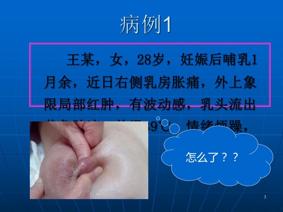 急性乳腺炎课件-2.ppt_第3页